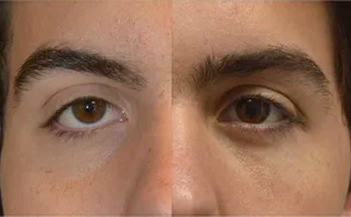 Picture of hunter eyes before and after mewing